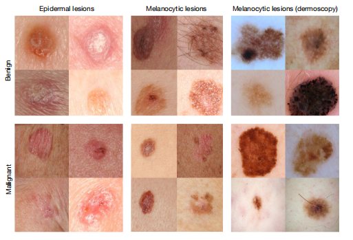 【医学影像】《dermatologist-level classification of skin cancer
