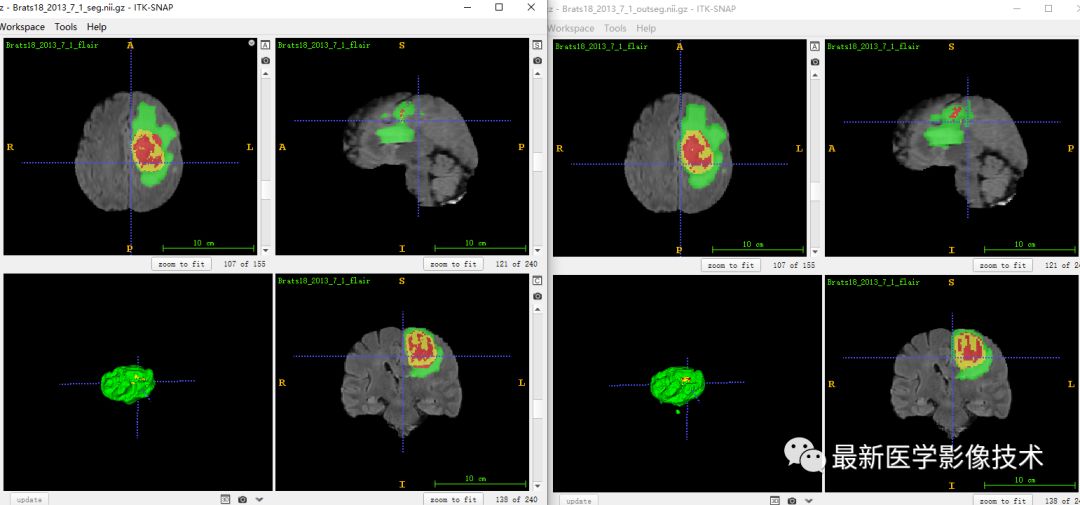 BraTS18——多模态MR图像脑肿瘤分割挑战赛续4 