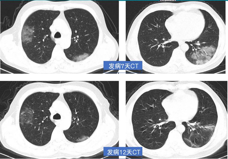 了解新冠的影像学表现为机器学习作准备