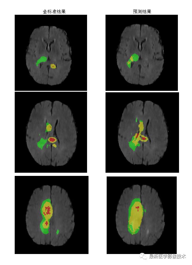 BraTS18——多模态MR图像脑肿瘤分割挑战赛续 