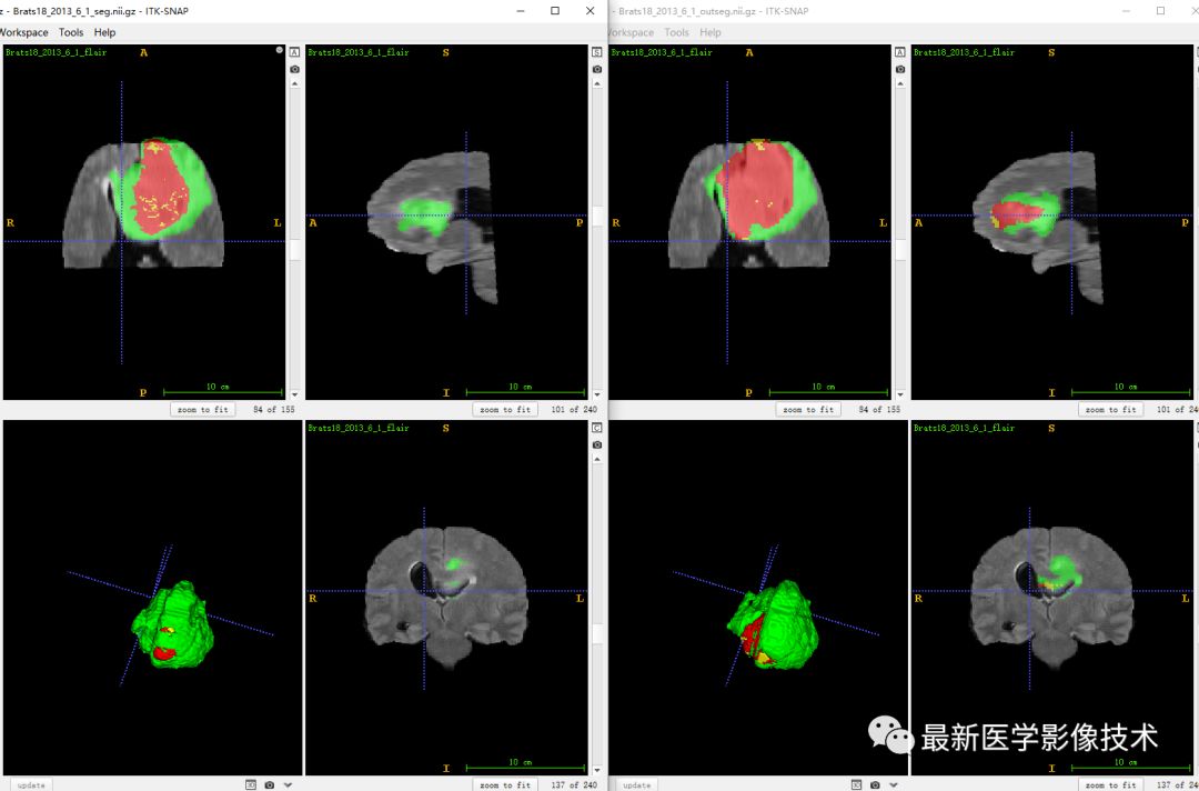BraTS18——多模态MR图像脑肿瘤分割挑战赛续3 