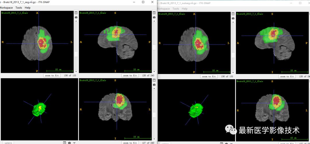 BraTS18——多模态MR图像脑肿瘤分割挑战赛续7 