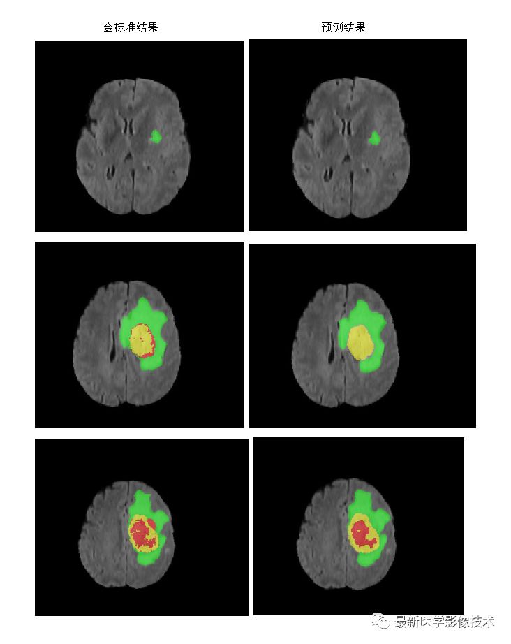 BraTS18——多模态MR图像脑肿瘤分割挑战赛 