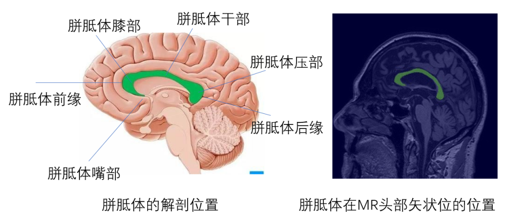 大脑矢状位解剖图图片